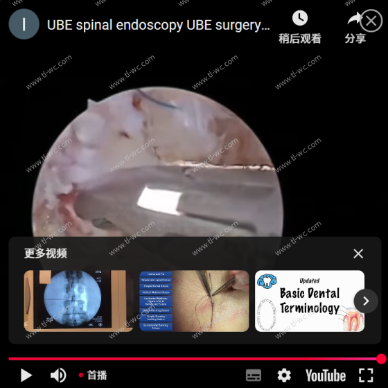 UBE spflanzspiegel endometriose wing wing wing wing video