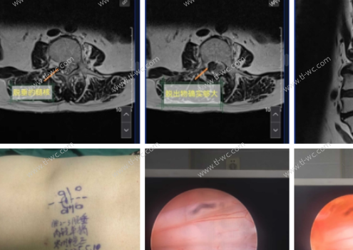 Caso di trattamento di sporgenza gigante elevata del disco lombare con discectomia lombare endoscopica percutanea